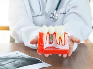 dos and donts of dental implants
