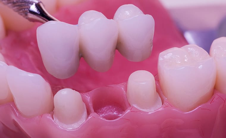 Dental Bridges application in Anoka Dental