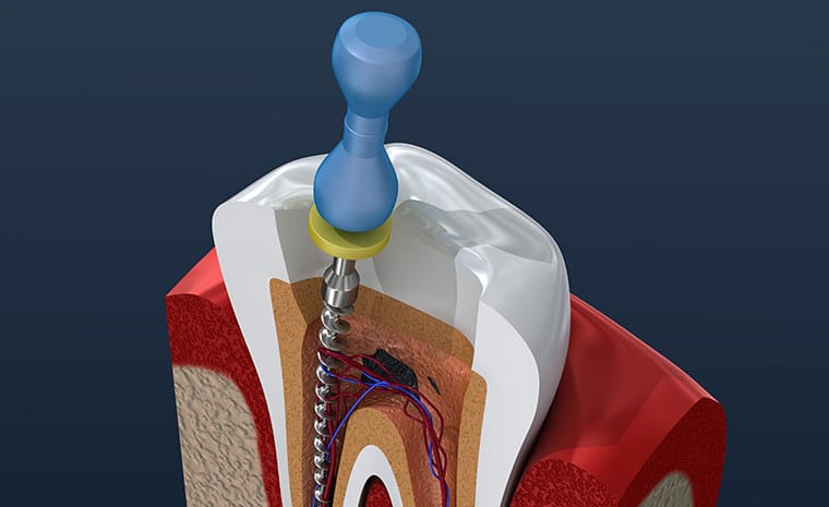 Root Canal Therapy illustration Anoka Dental