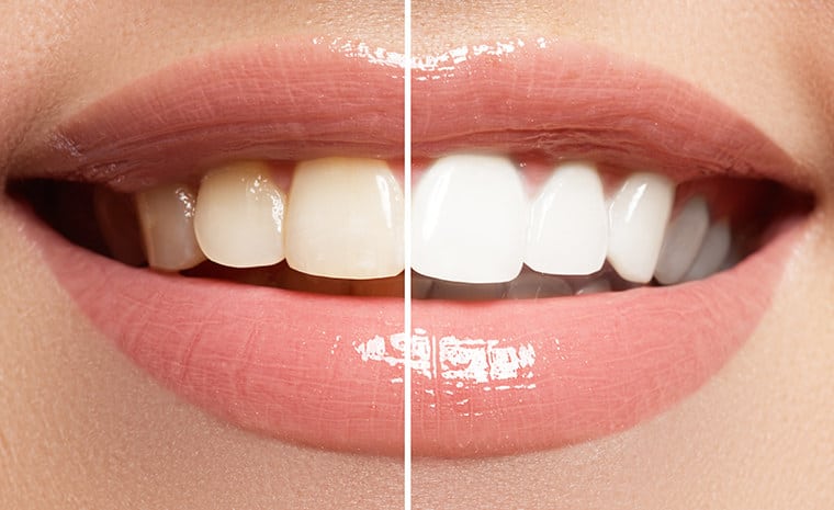 Teeth Whitening before and after Anoka Dental 1