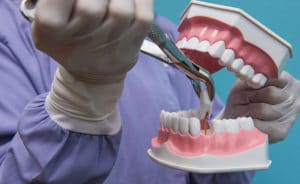 Tooth Extraction procedure model