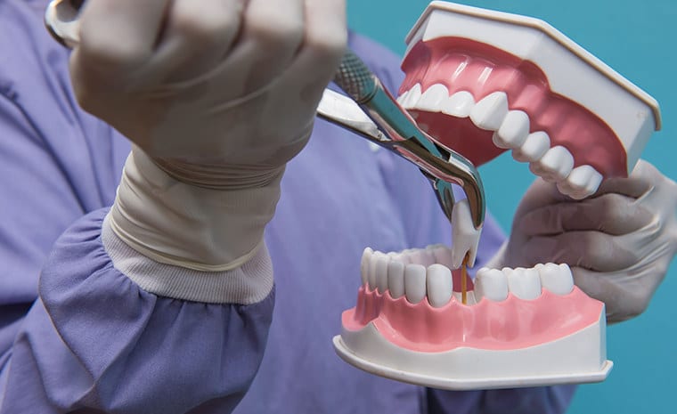 Tooth Extraction procedure model