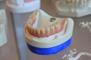 Periodontitis - Anoka Dental