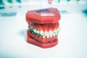 Myths :: Lingual braces, Ceramic braces, Invisible braces