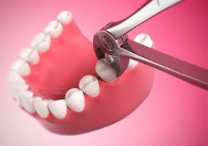 Tooth Extraction procedure Anoka MN
