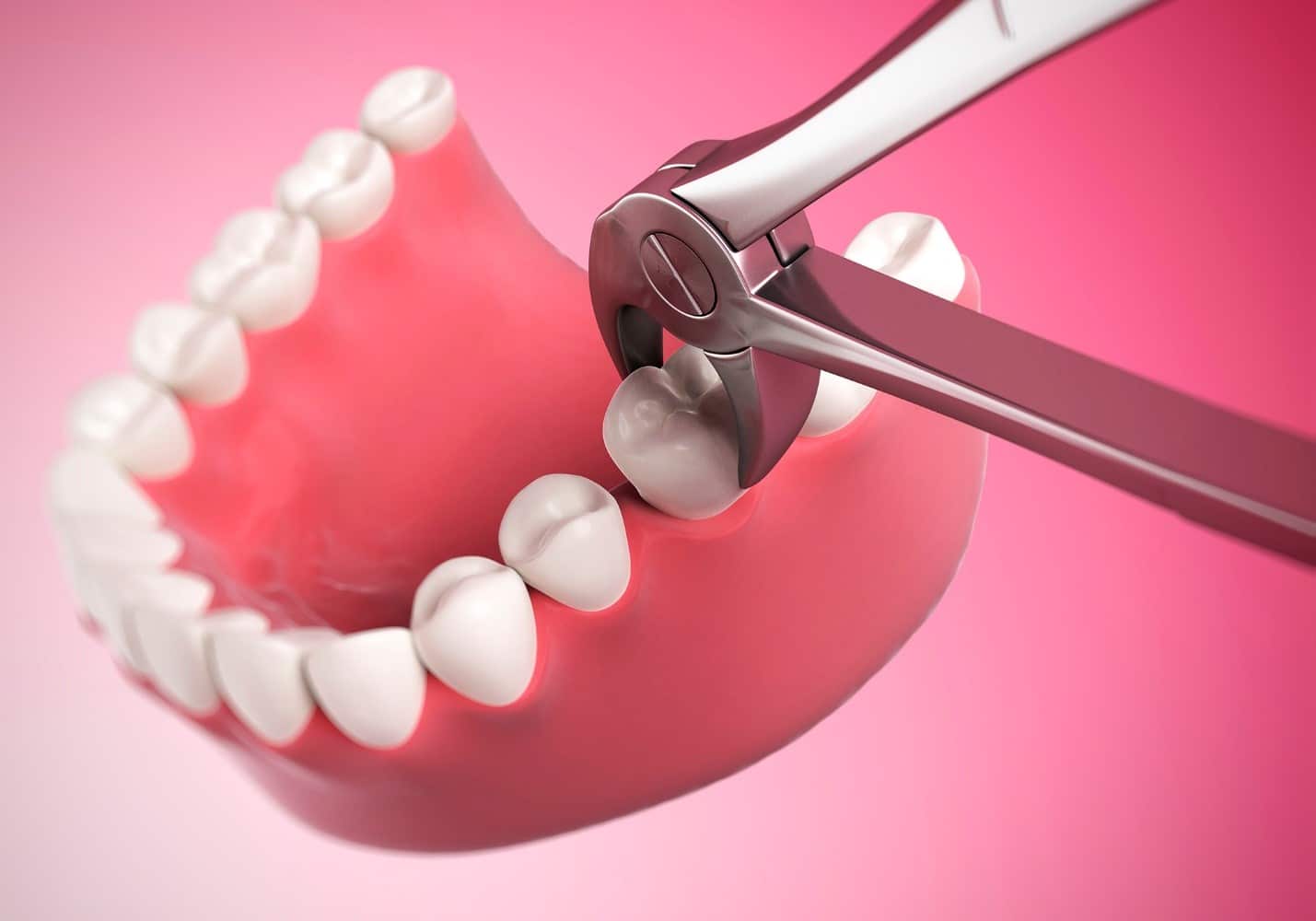 Tooth Extraction Pain How Long Does It Take To Go Away? Anoka Dental