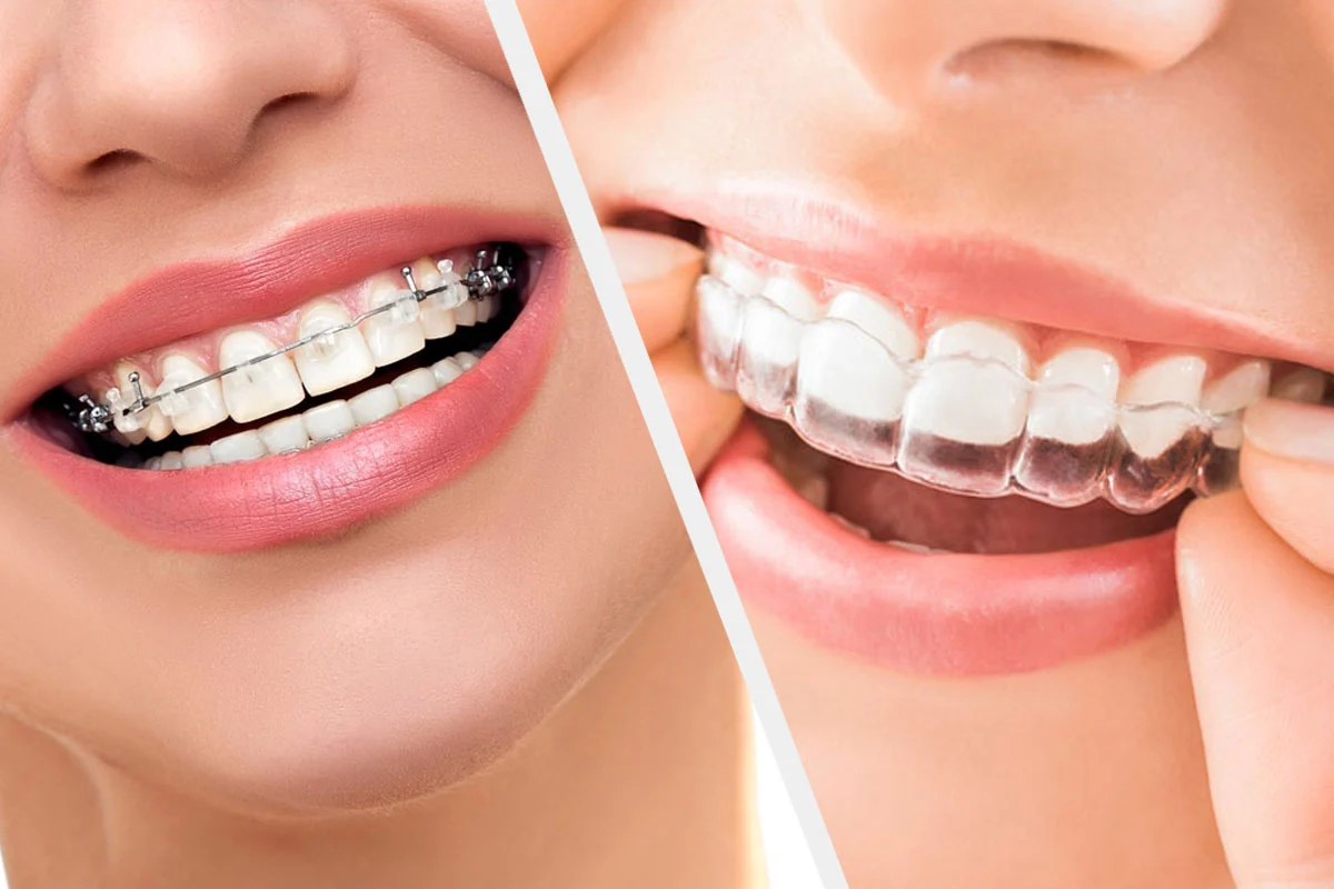 Teeth Aligners vs Braces