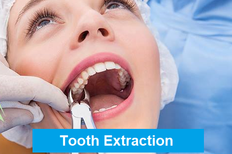 Tooth Extraction Aftercare