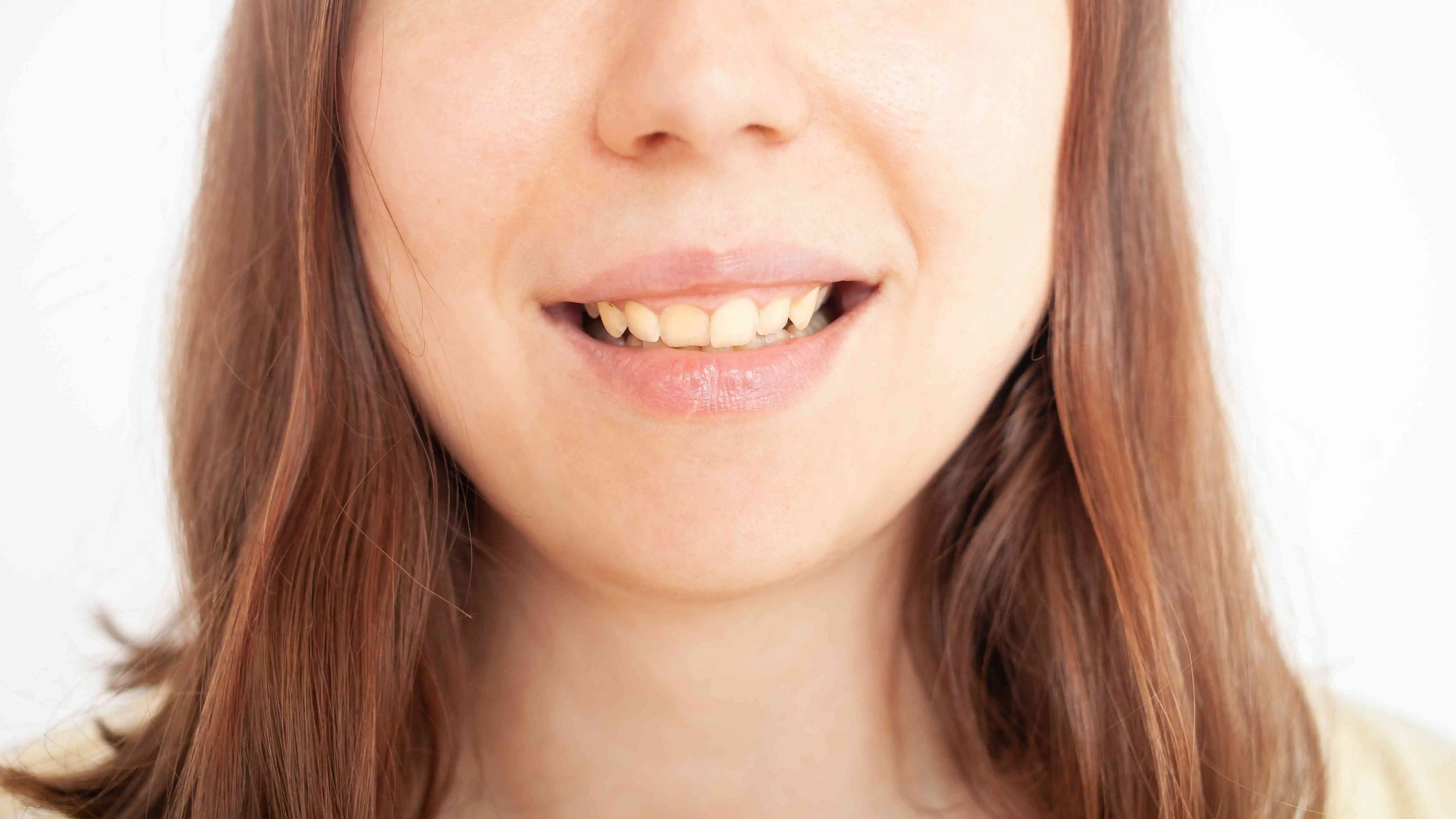 Teeth Whitening For Yellow Teeth