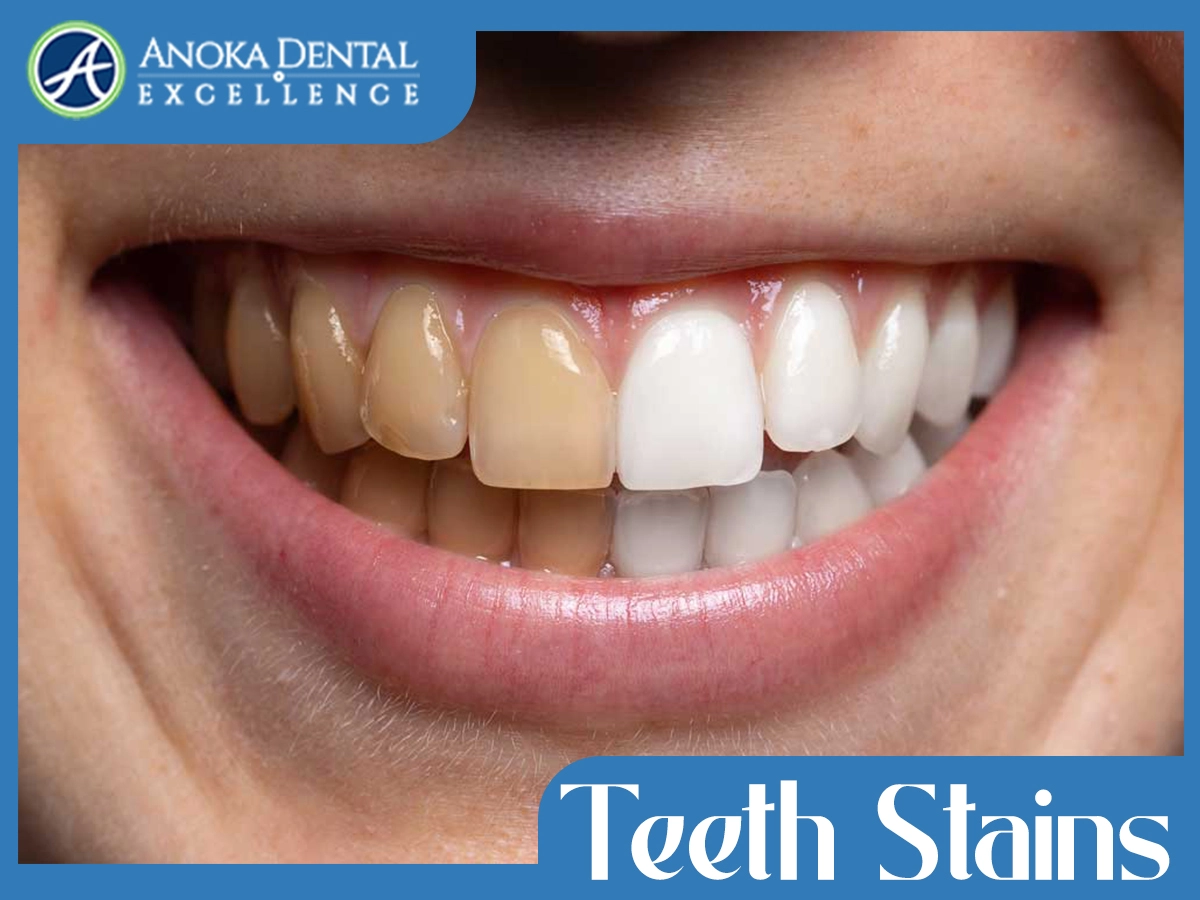 Teeth Stains Causes, Types, and How to Remove Them