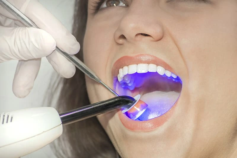 tooth curing after filling for young woman