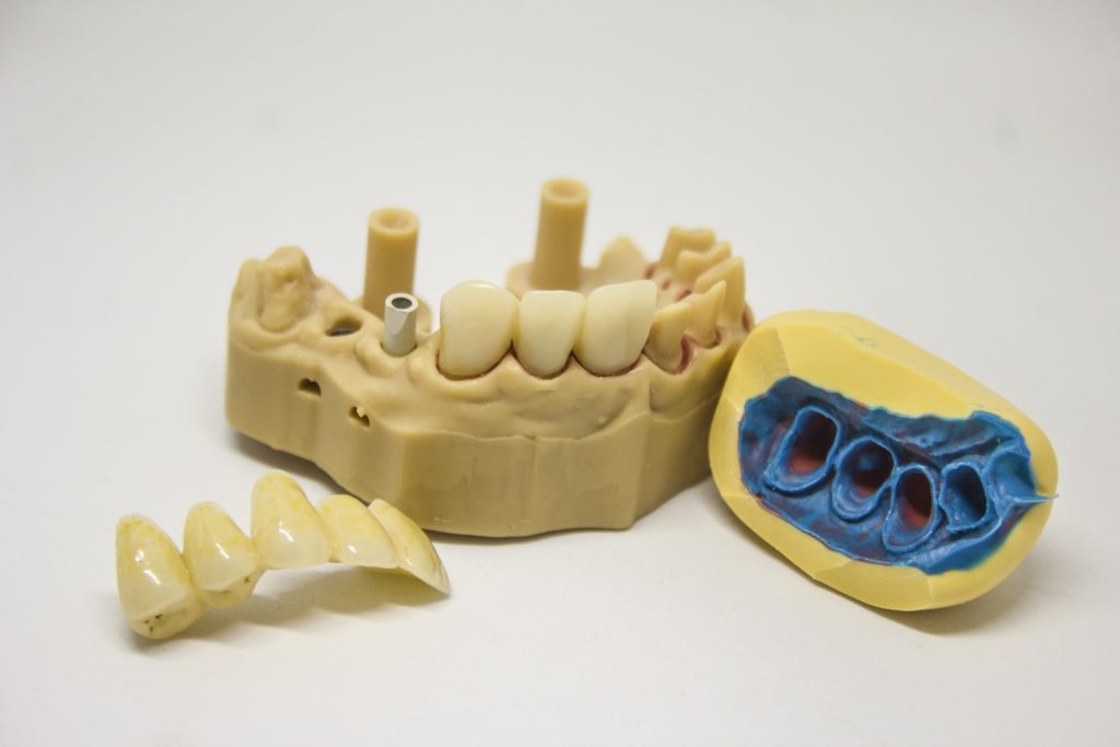 symptoms of ill-fitting dental bridge