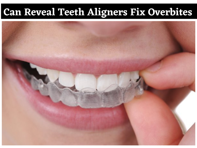 Can Reveal Teeth Aligners Fix Overbites?