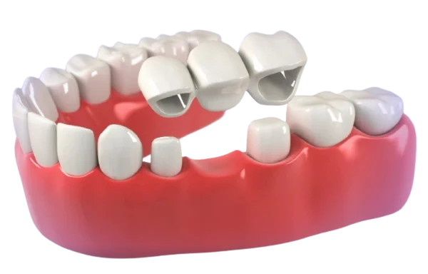 What Is Dental Bridge