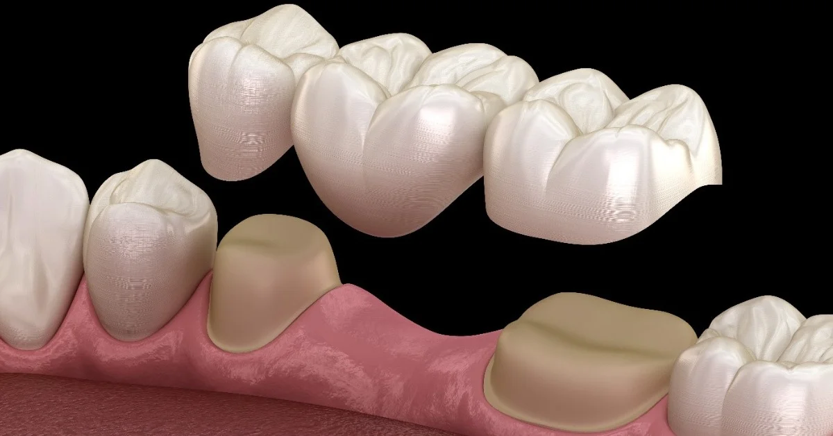 Symptoms of Ill Fitting Dental Bridge