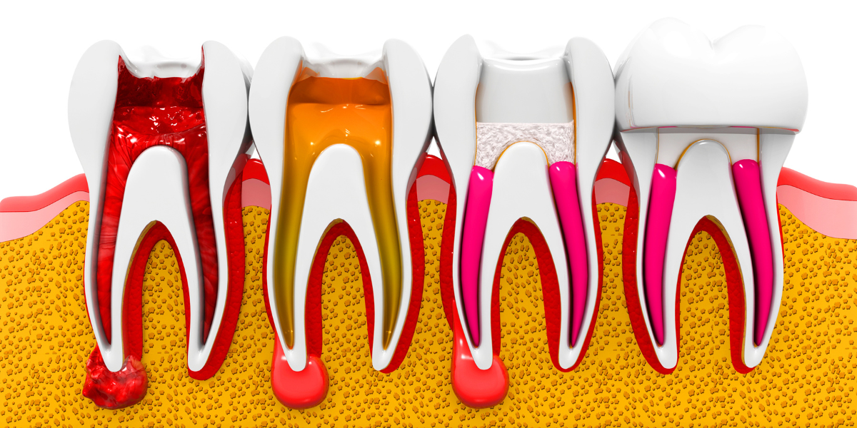 What are the Disadvantages of a Root Canal