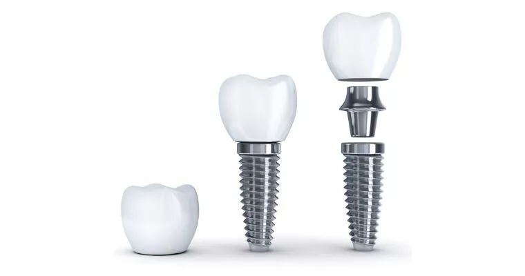Components of a Dental Implant