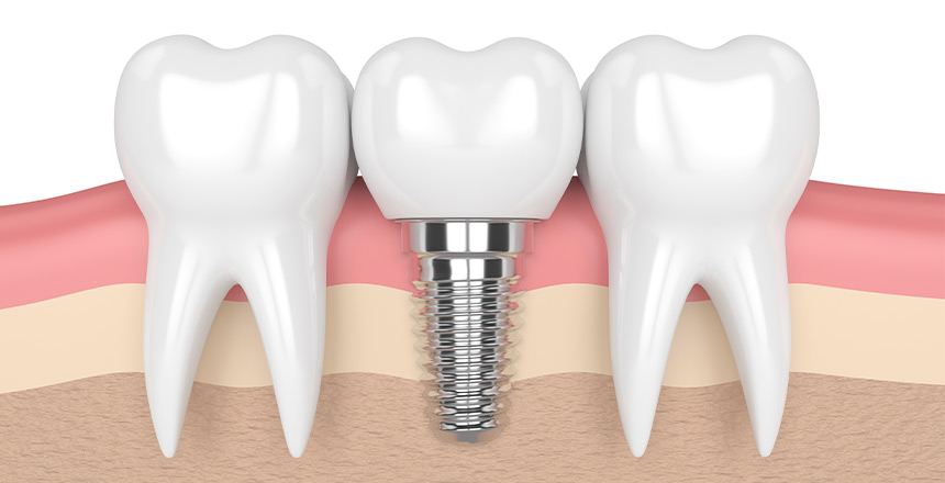 Tooth Replacement Options