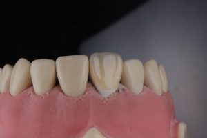 front tooth crown