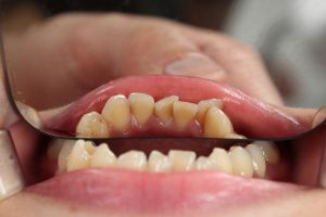 plaque vs tartar