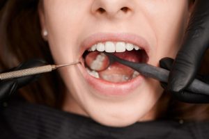cavity on side of tooth