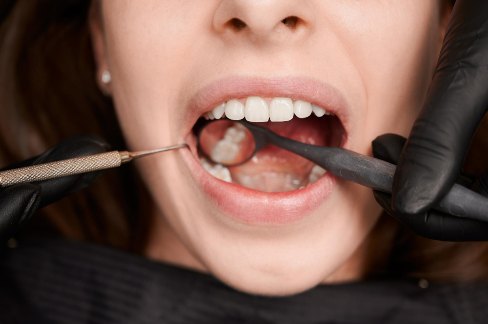 cavity on side of tooth