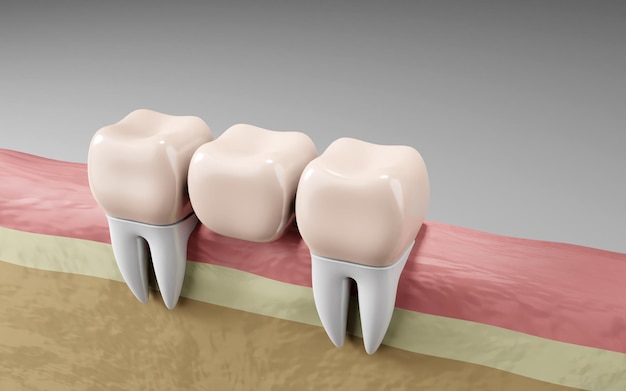 bridges for teeth​