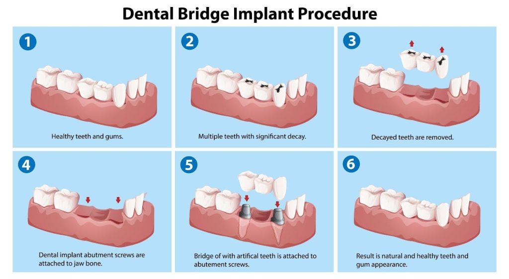 types of bridges for teeth