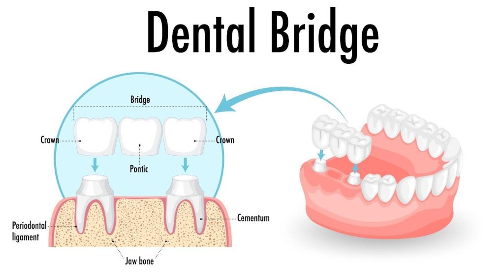 what is a bridge for teeth
