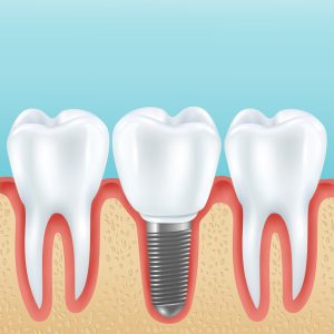dental implant healing stages
