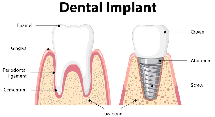 what are the 3 types of dental implants