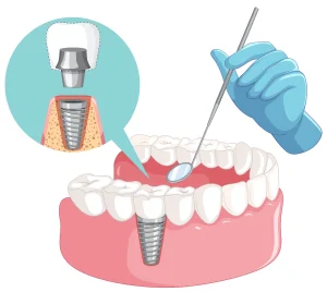 what are dental implants