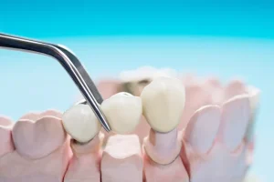 single tooth bridge