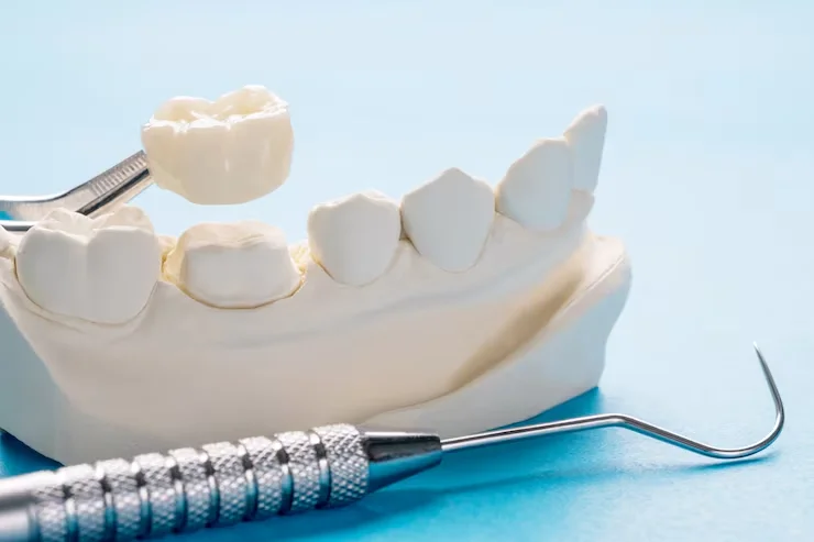 teeth filling vs crown